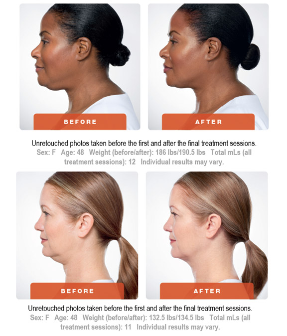 Kybella for a Chiseled Jawline, Utah Facial Plastics