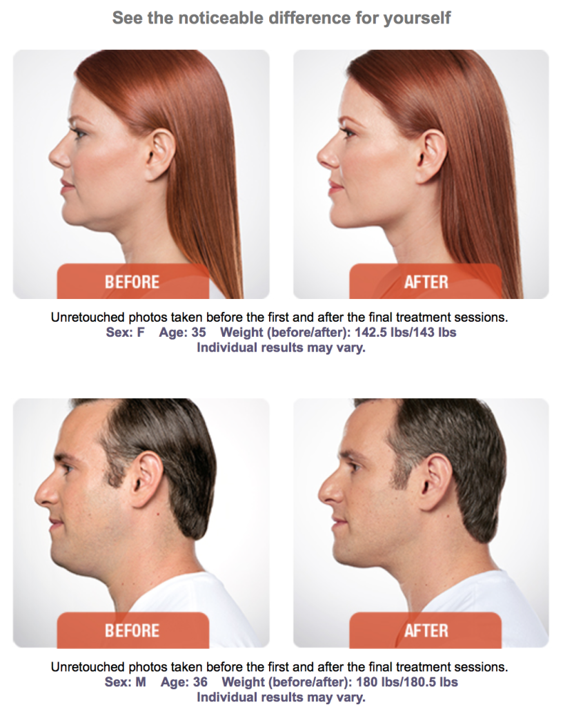 Sculpt Countour The Jawline With Kybella Kybella Fat Reduction